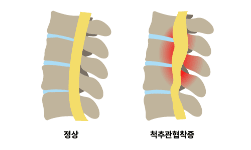 척추관협착증