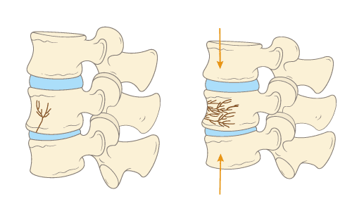 척추압박골절