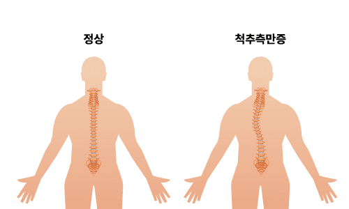 척추측만증