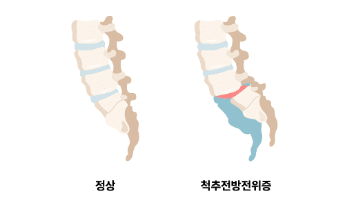 척추전방전위증