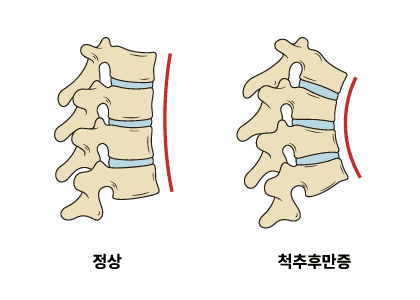 척추후만증